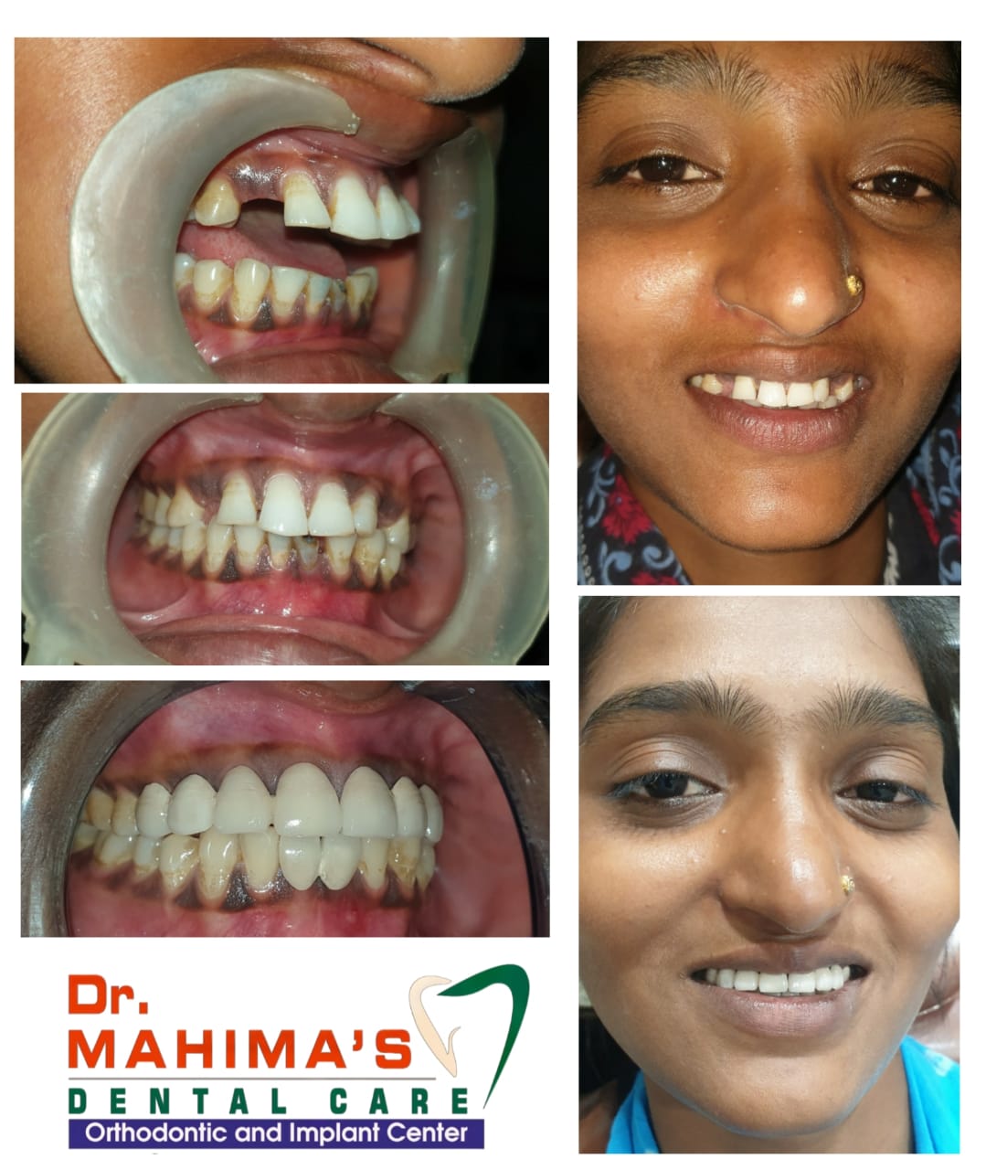 After smile design treatment